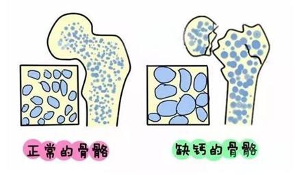 不想讓骨頭變脆，這4件事一定要少做！